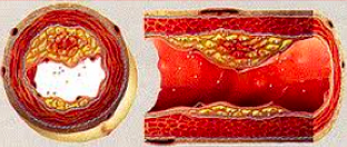Στεφανιαία Νόσος - CAD coron artery